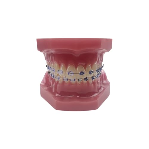 Orthodontic demonstration model with metal brackets